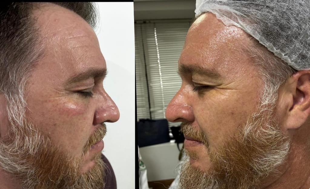 Procedimento de estética facial