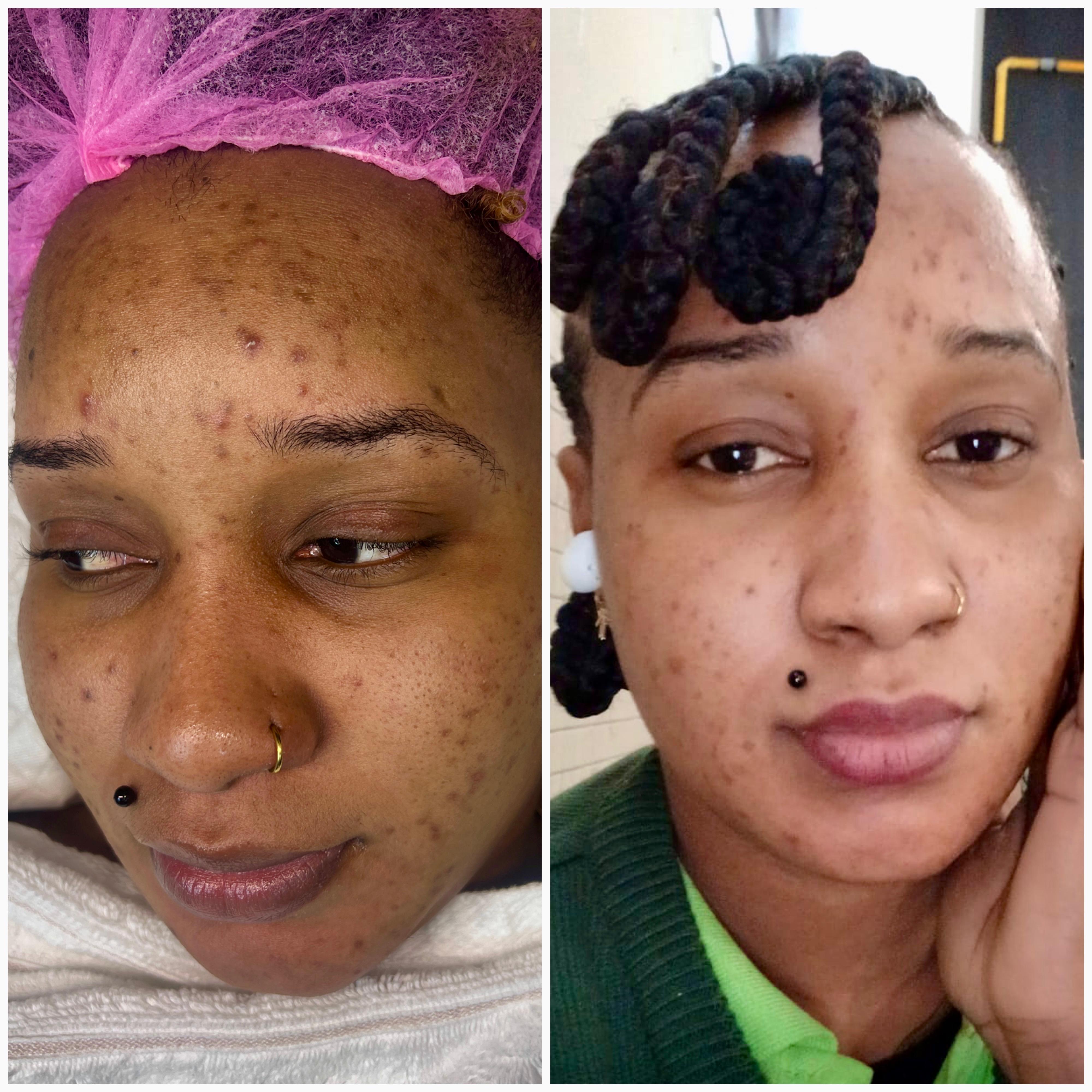 Procedimento de estética corporal